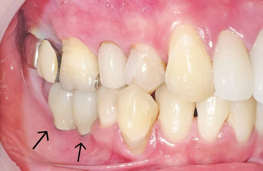 40代男性のインプラント（歯2本分）：治療後