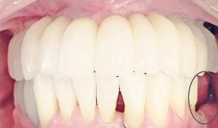60代男性のインプラント（歯1本分）：治療前