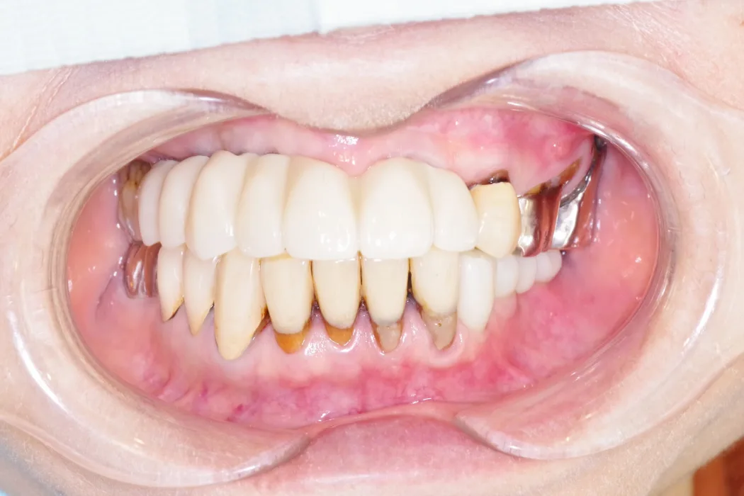 70代男性のインプラント（歯8本分）：治療後